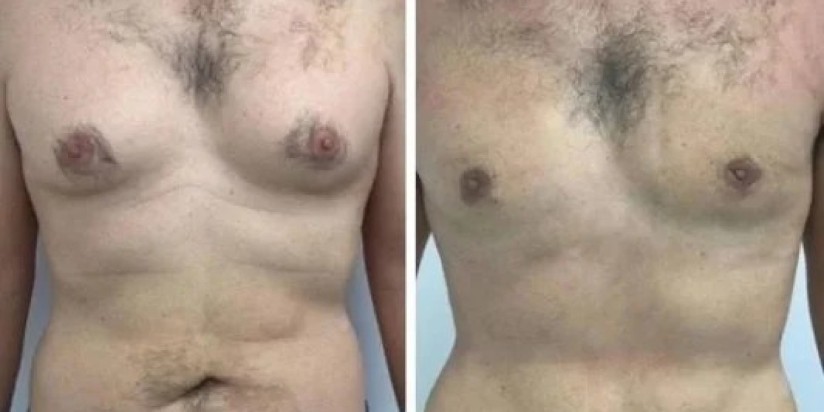 Best Gynecomastia Surgeons in Dubai: Achieving Symmetrical Chest Results