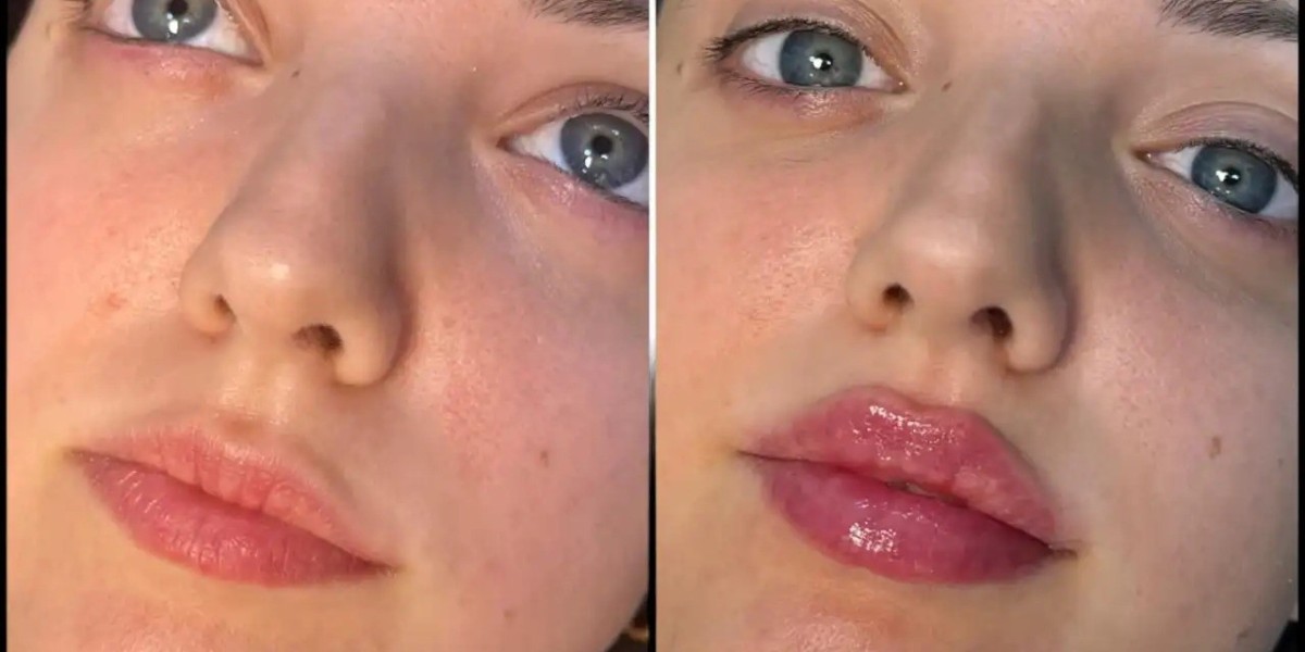 Safe and Professional Fillers at Best Aesthetic Clinics in Dubai