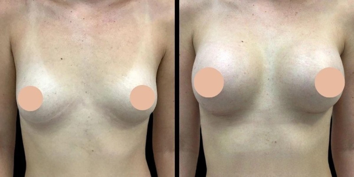 How the Best Breast Augmentation Surgeons in Dubai Plan Your Breast Augmentation